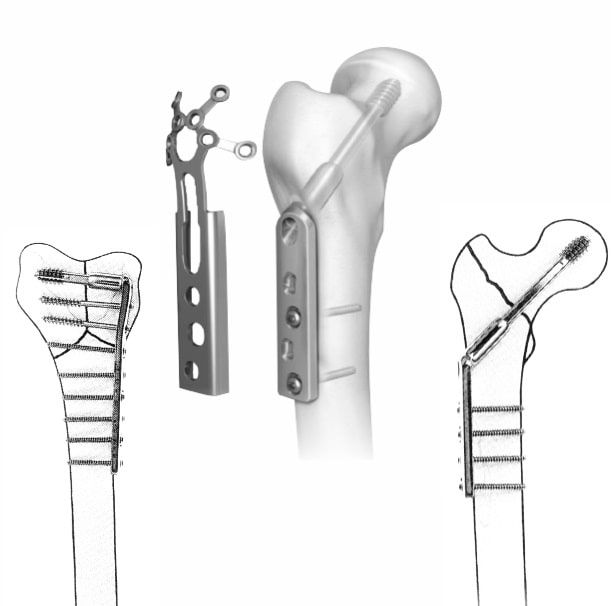 Implants And Fixators